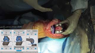 Measured Resection Approach in TKA with Joseph Locker MD [upl. by Ydaf]