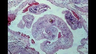 Schistosomiasis  Pathology mini tutorial [upl. by Eerrahs]