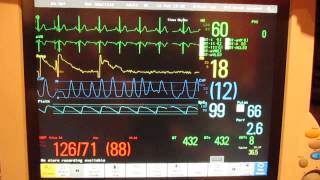 Kardiomonitor [upl. by Moreta]