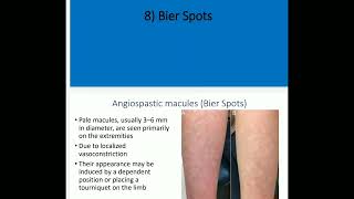 3 Acquired hypomelanosis by Dr Mohamed Aidaros [upl. by Ennaid]