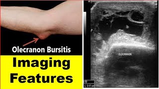 Olecranon bursitis Imaging features [upl. by Nagol645]