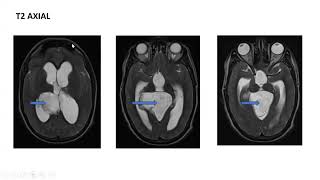 Harsh Choudhary  MRI EVALUATION OF EPIDERMOID CYST IN VARIOUS LOCATIONS mriteachingcourse [upl. by Arraic323]