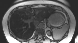 Hepatic Steatosis [upl. by Blainey]