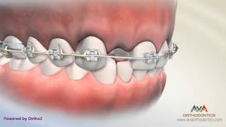 Orthodontic amp Restorative Treatment for Missing Lateral Incisor  Different Options [upl. by Kreindler]