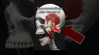 Temporomandibular Joint Dysfunction TMJ  TMD [upl. by Manon]