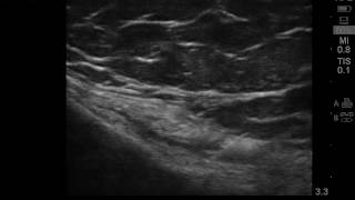 Ultrasound guided pes anserine bursitis injection [upl. by Mensch]