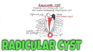 Radicular cyst  Periapical Cyst  Pathogenesis Clinical RF HF amp Treatment [upl. by Boru657]