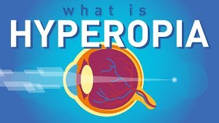 What is Hyperopia Farsightedness [upl. by Myrlene]