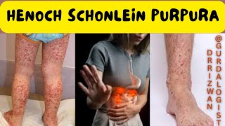 HenochSchonlein Purpura HSP  Symptoms  Cause  Pathology  Biopsy  Treatment  Transplant [upl. by Stephenie]