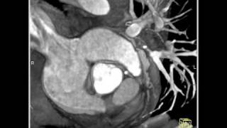 Cardiac Circumflex arises off RCA right coronary artery 3 of 3 [upl. by Ennovi]