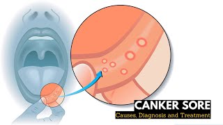 What is CANKER SORES Causes Signs and Symptoms Diagnosis and Treatment [upl. by Ardnos]