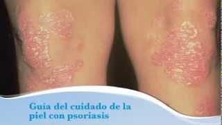 Guia del cuidado de la piel con psoriasis [upl. by Boucher]