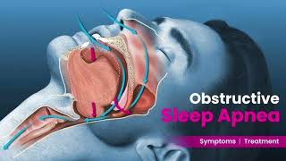 OSA Obstructive sleep apnoea Video station mrcpch Clinical [upl. by Ahsauqram]