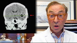 CRAZY Story 🧠 Brain Abscess From an Infected Tooth 🦷 [upl. by Massey]