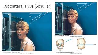 Radiographic Positioning of the TMJs [upl. by Gagne427]