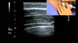 Transverse Abdominis Plane Block ultrasound guided [upl. by Grishilda562]