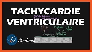 Tachycardie Ventriculaire ECG symptômes et traitement [upl. by Fatma]