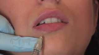 Lippenunterspritzung mit Juvederm Volbella  PULLMANN [upl. by Graybill367]