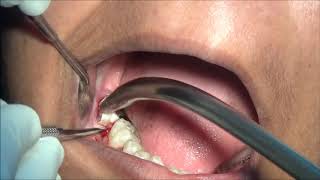 Angled coupland elevator for removing lower second molar [upl. by Noslien]