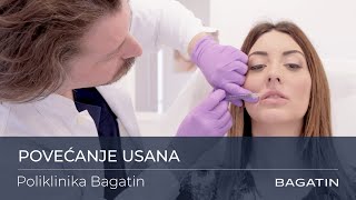 Povećanje usana dermalnim filerima u Poliklinici Bagatin [upl. by Ennayrb]