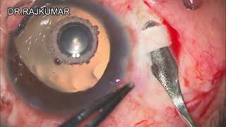 CMT FLEX SCLERAL FIXATION INTRAOCULAR LENS FOR APHAKIA [upl. by Ophelia445]