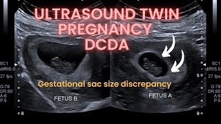 Ultrasound twin pregnancy gestational sac discrepancy Dichorionic diamniotic twin pregnancy [upl. by Shawn]