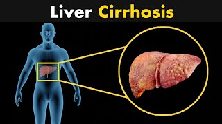 What is liver cirrhosis  Symptoms Diagnosis and treatment 3D Animation [upl. by Norrahc]