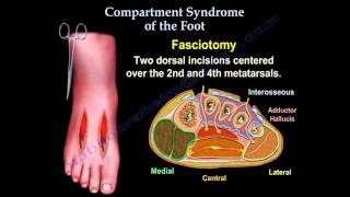Síndrome Compartimental do Pé [upl. by Bromleigh18]