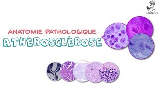 Anatomie Pathologique  Athérosclérose [upl. by Hareemas838]