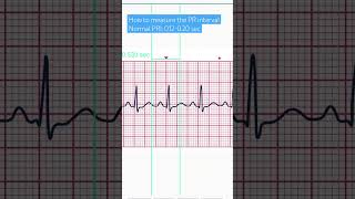 How to measure the PR interval [upl. by Nnagrom737]