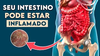 INTESTINO INFLAMADO Sintomas de Doença Inflamatória Intestinal │ Doença de Crohn [upl. by Cornia526]