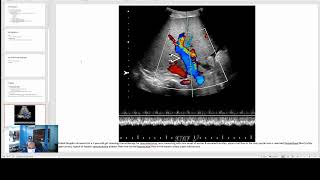 Hepatic Venoocclusive Disease [upl. by Marissa]