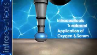 How does the Oxygen Facial work [upl. by Karlow]