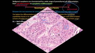 113P How to tell a benign and malignant tumor apart Differentiation and Anaplasia [upl. by Emorej359]