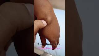 ganglionic cyst [upl. by Afatsom568]