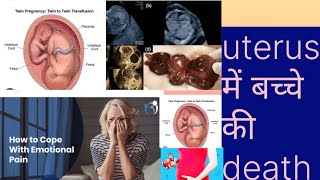 Fetal death inside uterusFetal demiseबच्चे की धड़कन गर्भ में रुक जाना IUFDDr Naima Bano [upl. by Mathia469]