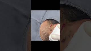 An Ear Cyst You Dont Want to Miss [upl. by Eintihw]