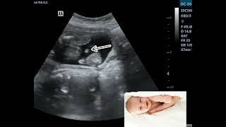 Ultrasound Showing Baby Boy in breech Presentation [upl. by Haerdna]