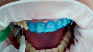 Veneer Case with FirstFit Technology  StepbyStep Procedure [upl. by Telrahc299]