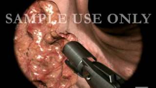 Colon Biopsy [upl. by Oirasan]