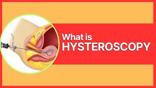 What is Hysteroscopy By Dr Mudita Jain [upl. by Odnomar514]