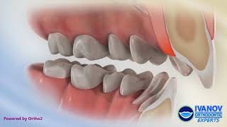 Improper Bite Consequences Excessive Overbite and Overjet [upl. by Ellocin]