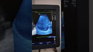 Pleural effusion Ultrasound [upl. by Keynes825]