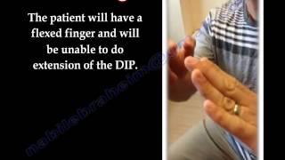 Mallet Finger  Everything You Need To Know  Dr Nabil Ebraheim [upl. by Orlov]