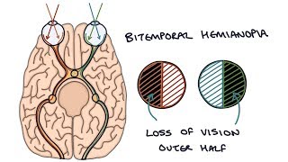 Understanding Bitemporal Hemianopia [upl. by Ciaphus]