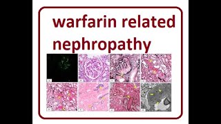 Warfarin Related Nephropathy  2024 [upl. by Gorman]