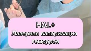 Halлазерная вапоризация геморроя дезартеризация под контролем узи [upl. by Naujat]