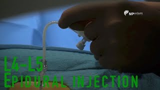 L4L5 epidural injection [upl. by Mosira460]