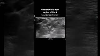 Neck Lymph Nodes ultrasound imaging cancerawareness cases [upl. by Flower]