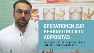 Operationen zur Behandlung von Adipositas Was passiert bei MagenBypass und SchlauchmagenOP [upl. by Ingvar]